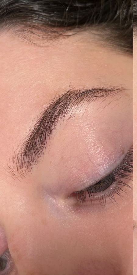 Brow Lifting – vorher