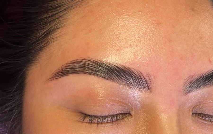 Brow Lifting – nachher