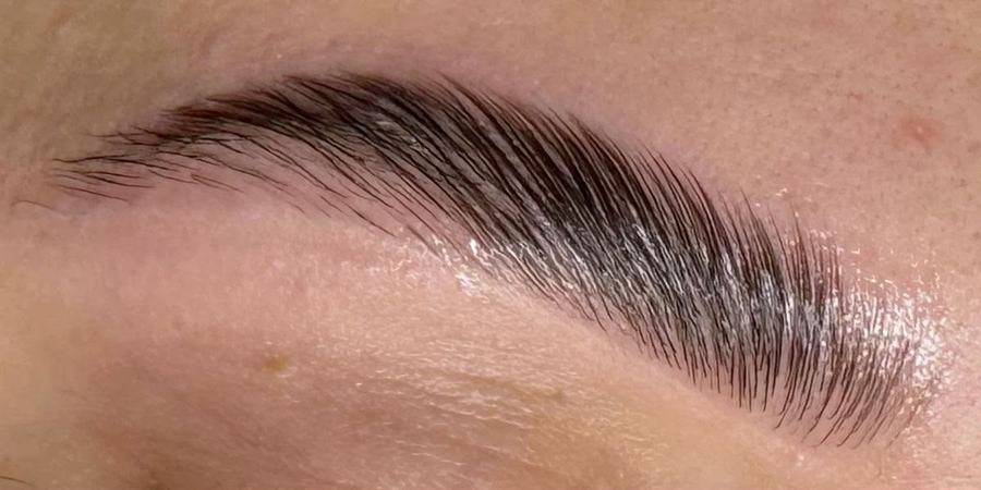 Brow Lifting – nachher