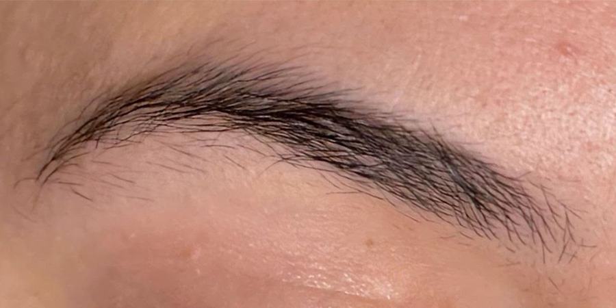 Brow Lifting – vorher