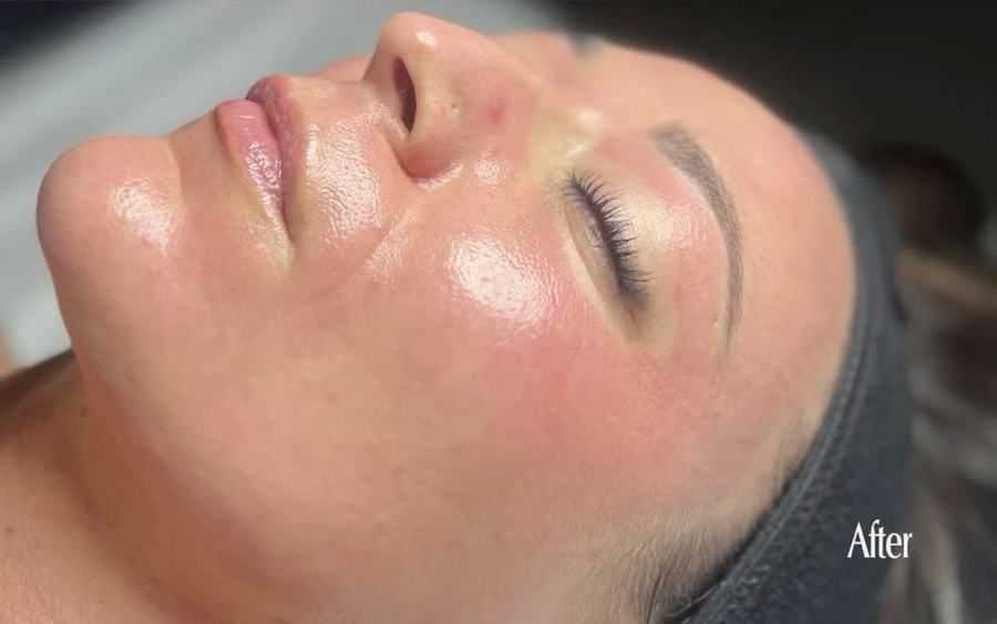 Glow & Frische – nachher