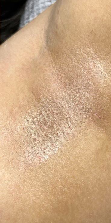 Waxing Achsel – nachher