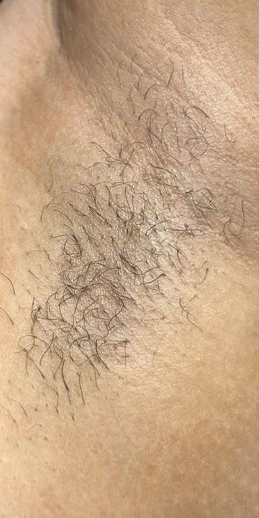 Waxing Achsel – vorher